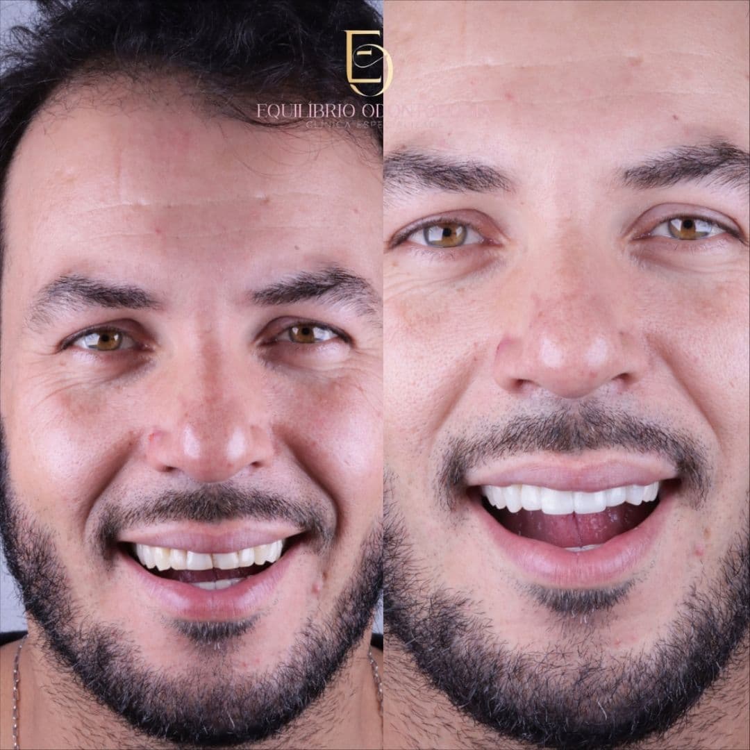 Antes e depois - resultado 1