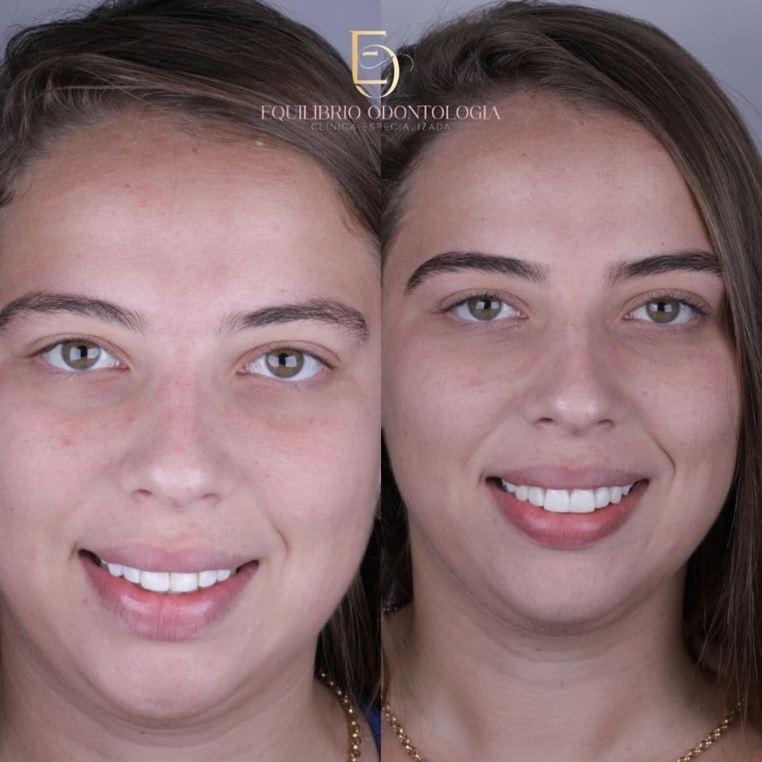 Antes e depois - resultado 2