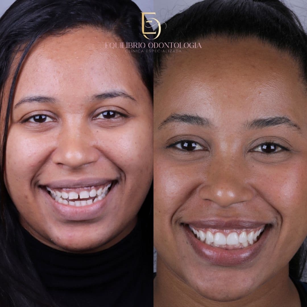 Antes e depois - resultado 3