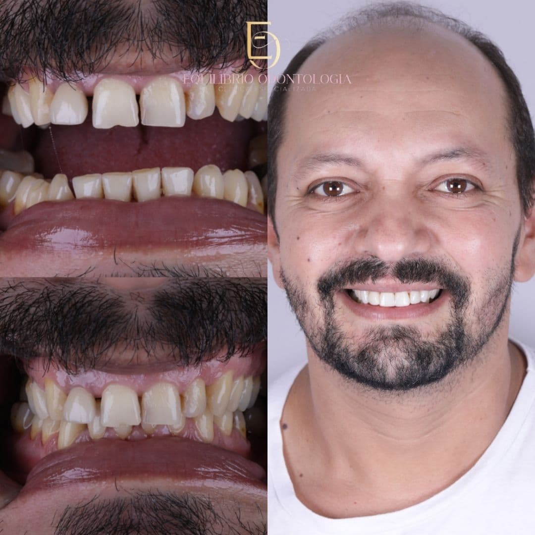 Antes e depois - resultado 4