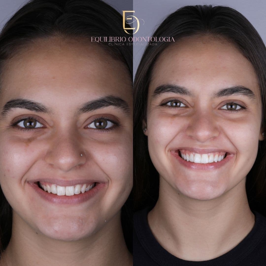 Antes e depois - resultado 5