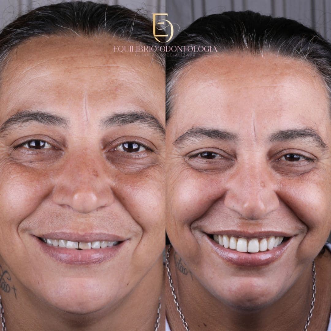Antes e depois - resultado 6