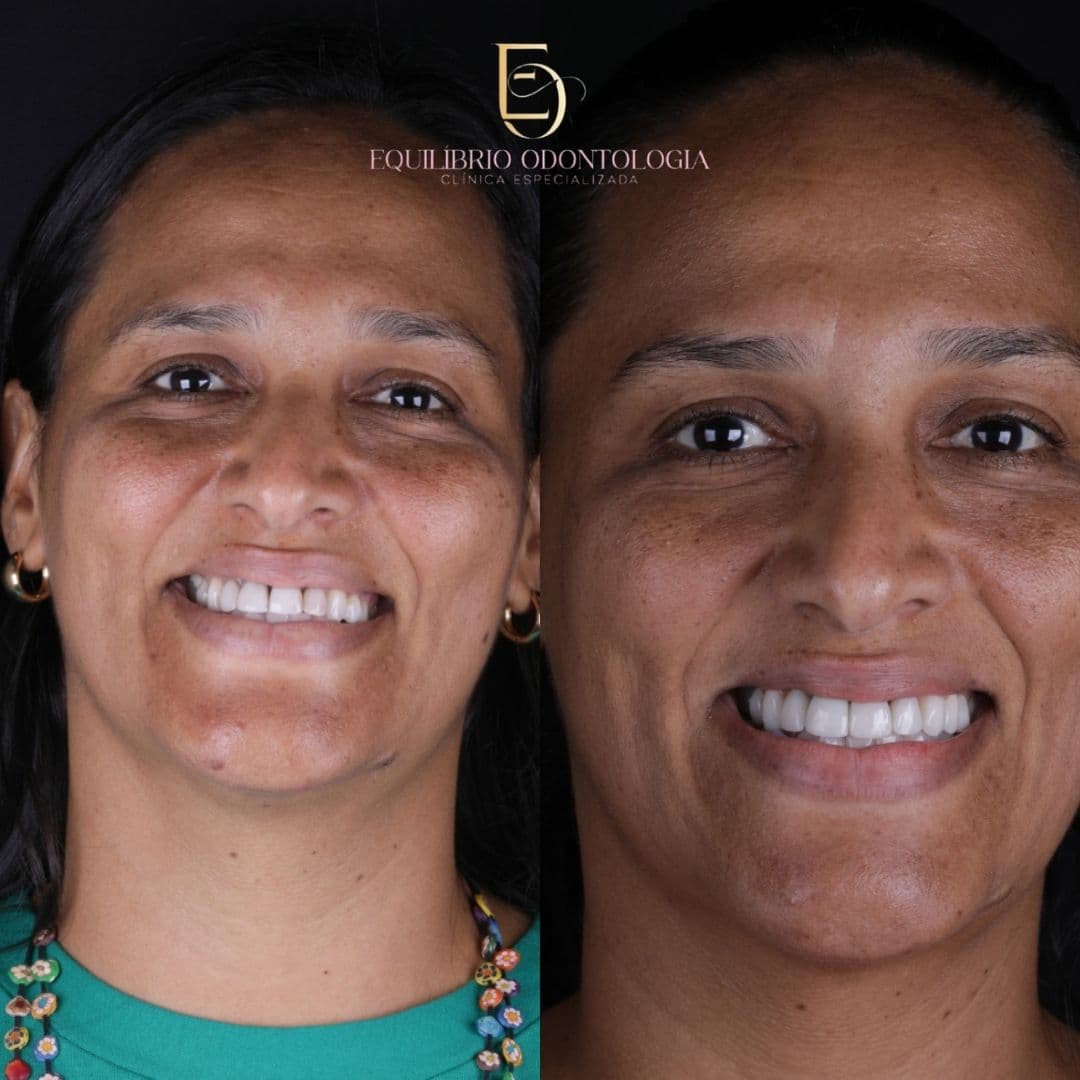 Antes e depois - resultado 7