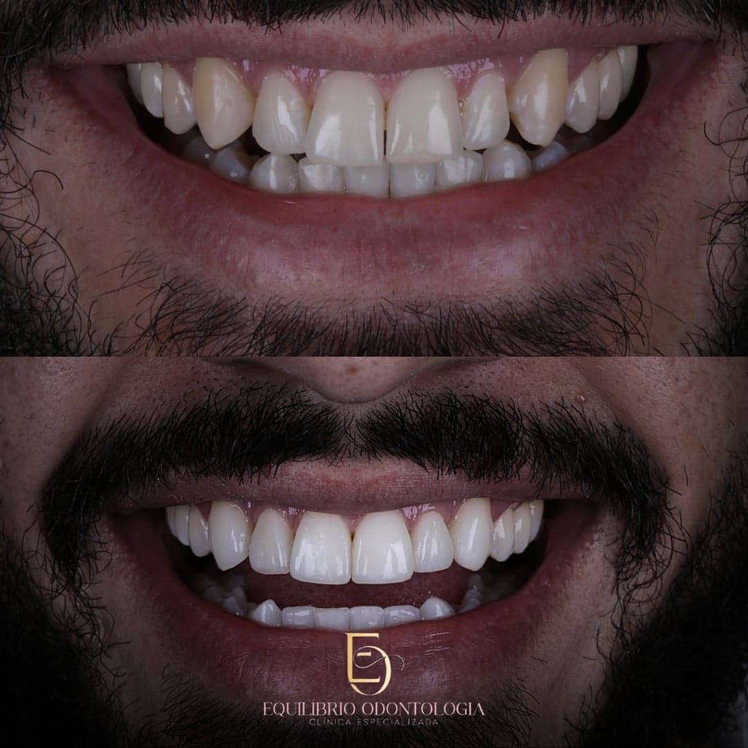 Antes e depois - resultado 1