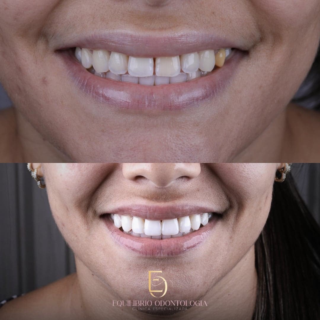 Antes e depois - resultado 10