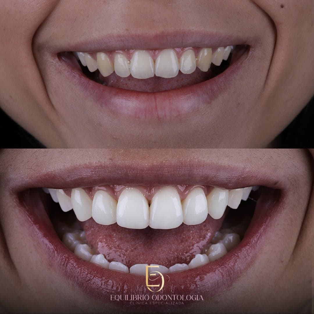 Antes e depois - resultado 2