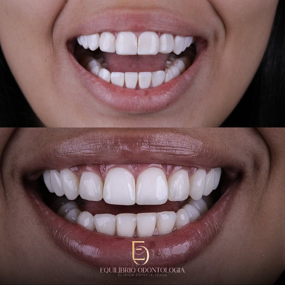 Antes e depois - resultado 3