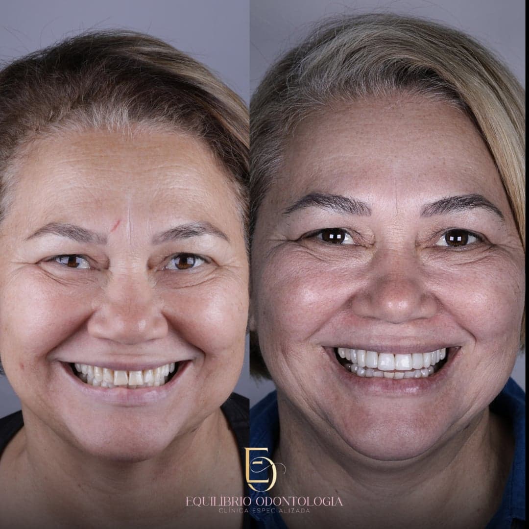 Antes e depois - resultado 4