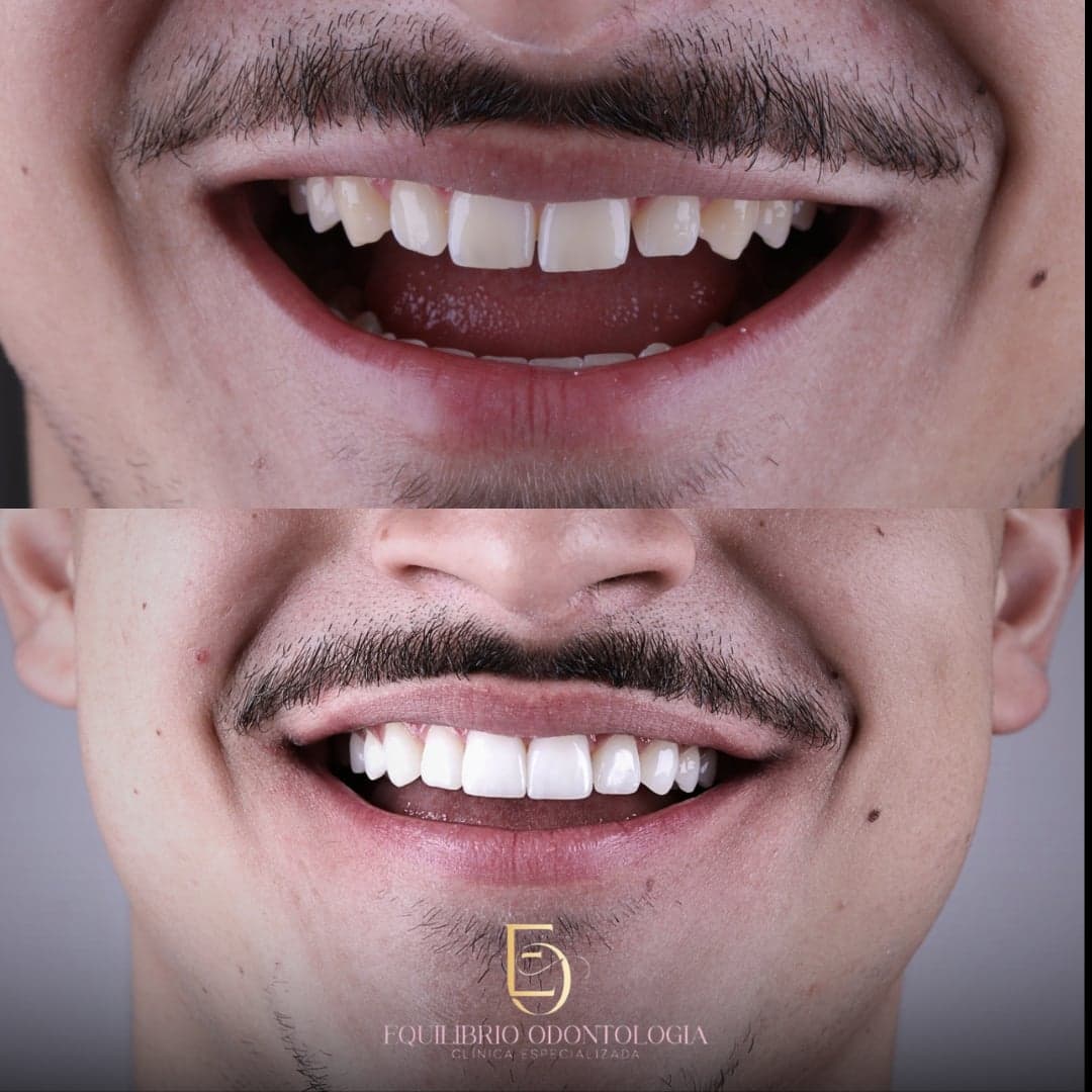 Antes e depois - resultado 5