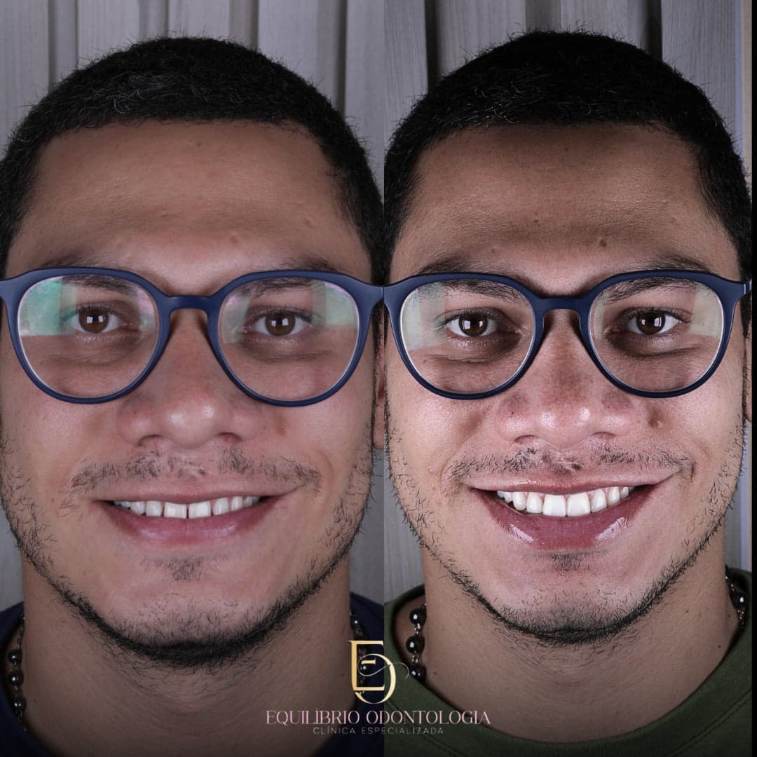 Antes e depois - resultado 6