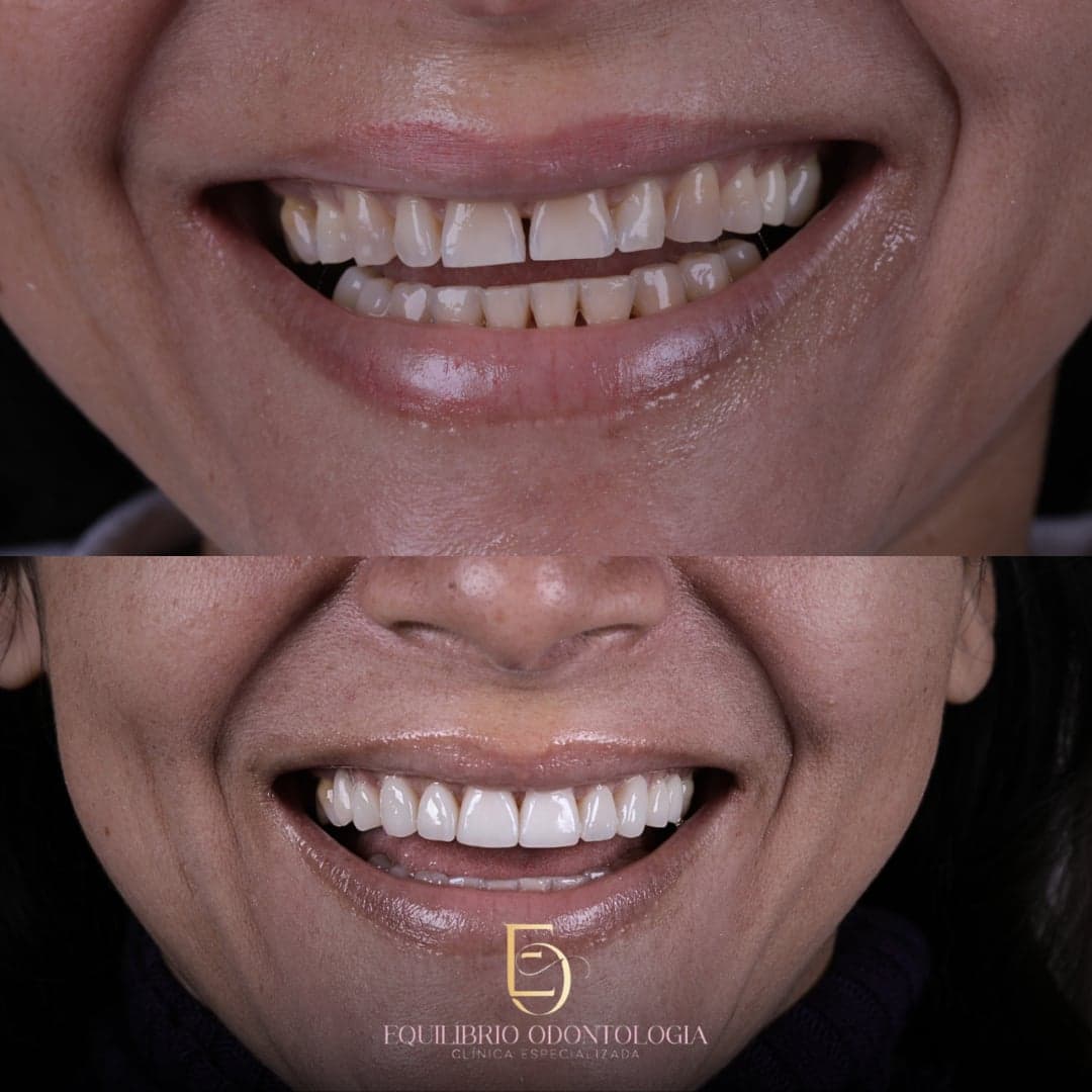 Antes e depois - resultado 7