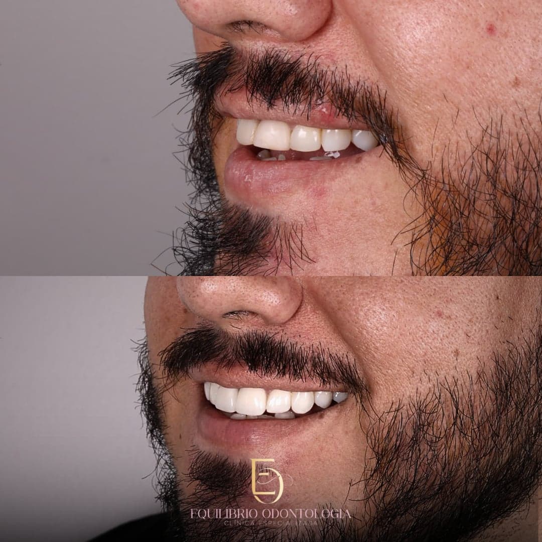 Antes e depois - resultado 8