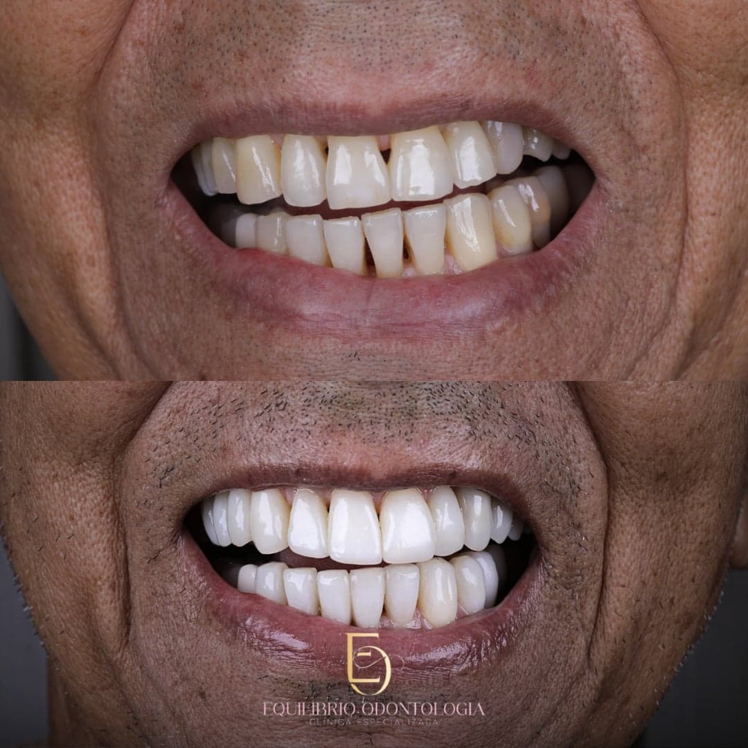 Antes e depois - resultado 9